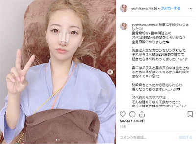 整形公表モデル・吉川ちか、230万円を費やした鼻の整形を終え経過報告「ナチュラルに仕上げてもらいました」（ねとらぼ）
