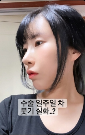 お笑い芸人イ・セヨン、鼻の整形手術後経過を公開「本当に一週目の腫れ？」(WoW!Korea)