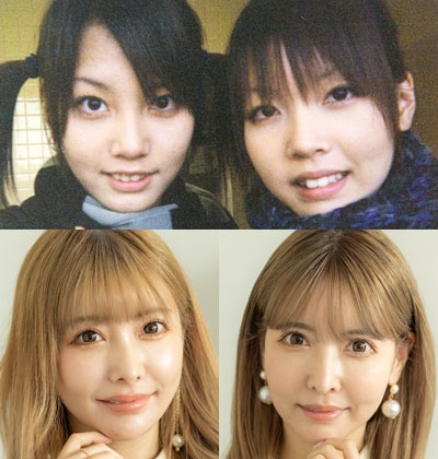 「彼氏よりも整形が最優先」“お互いを実験台”にしながら整形を重ねる双子モデルの美への執念(オリコン)