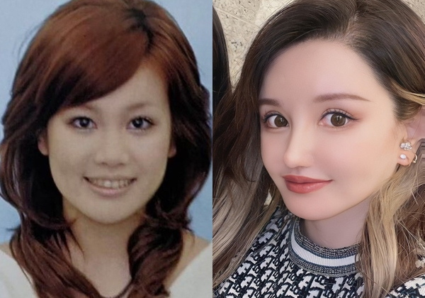 “離れ目の童顔になりたい”眼球の位置を変えようとした女性　“フル整形4周目”突入も「もうこれ以上はできないのがつらい」(オリコン)