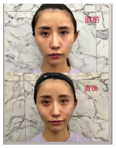 「ずっとずっと我慢していたの」元SDN48光上せあらが24時間断乳して美容整形　「全然違う！」大満足のビフォアフ公開(ねとらぼ)