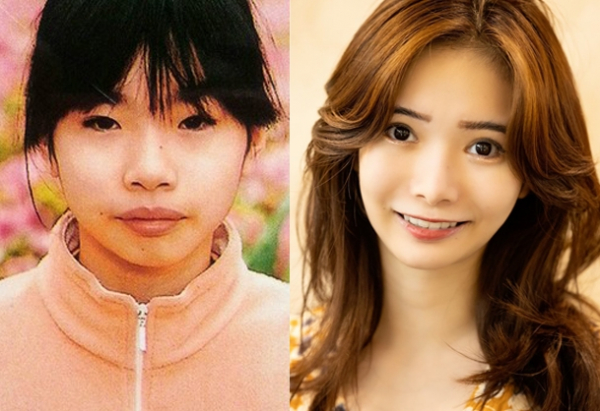 総額420万をかけてコンプレックスを解消　10回の施術から起業した女性「美容整形を努力だという文化を作りたい」(オリコン)