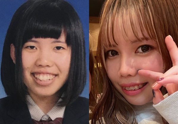 顎変形症の女性が整形で得たものとは？　「努力して可愛くなったんだね」自尊心を保てた彼氏からの言葉(オリコン)