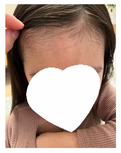 元SKE48メンバー、3歳娘の“顔のあざ”をレーザー治療することに　「やっぱり少し痛いみたいで可哀想だけど」と複雑な親心明かす(ねとらぼ)