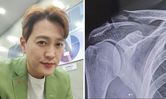 お笑いタレントのムン・チョンシク、自転車事故で鎖骨を骨折　「手術はしない」(朝鮮日報日本語版)