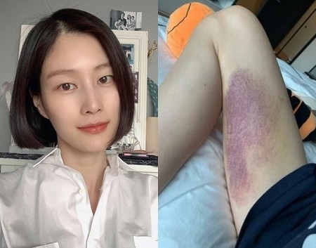 モデルのイ・ヒョニ、太ももに“大きなあざ”が…何事？「栄光の傷」(WoW!Korea)